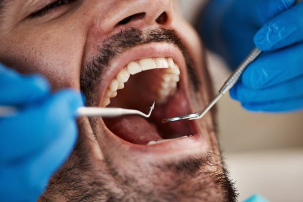 Best Emergency Wisdom Tooth Extraction in Jefferson City, TN